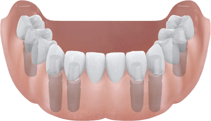 zahnimplantat aufbau erklärung würzburg